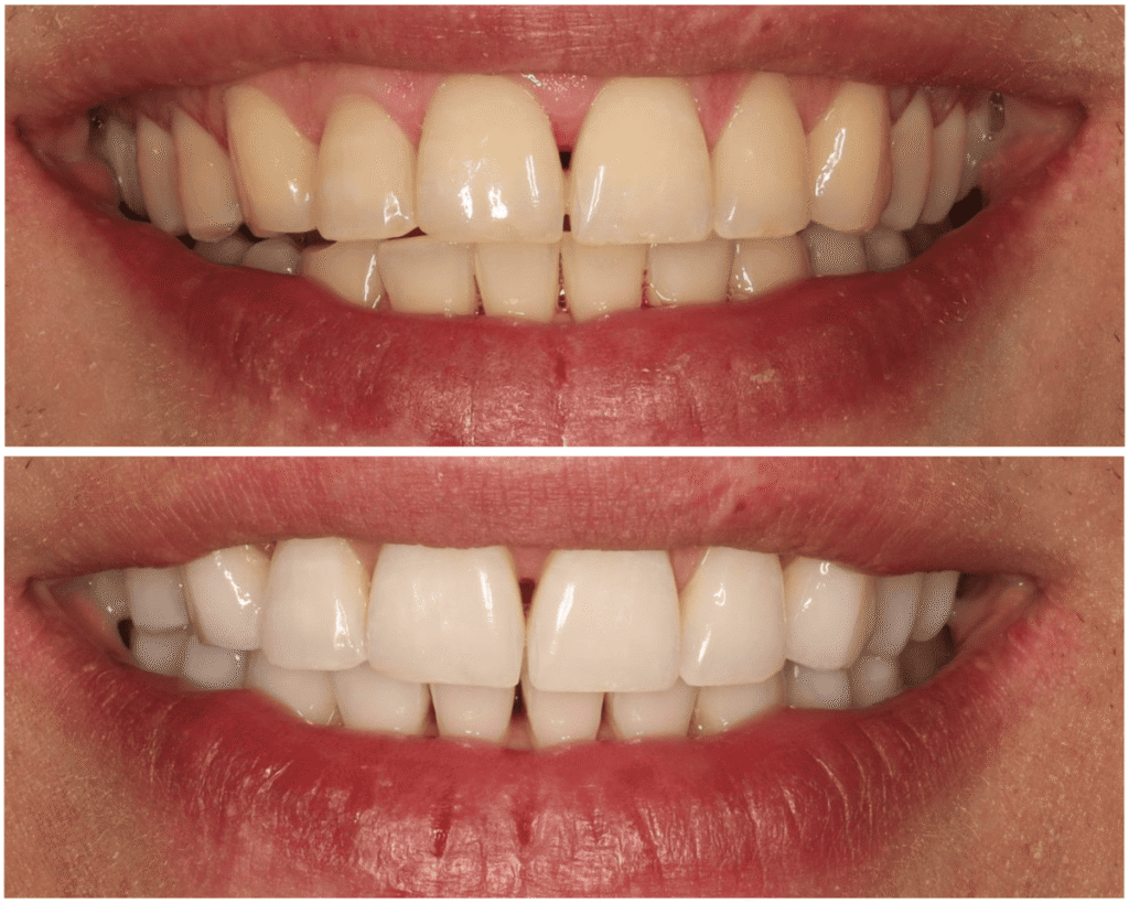 До і після відбілювання Art Whitening
